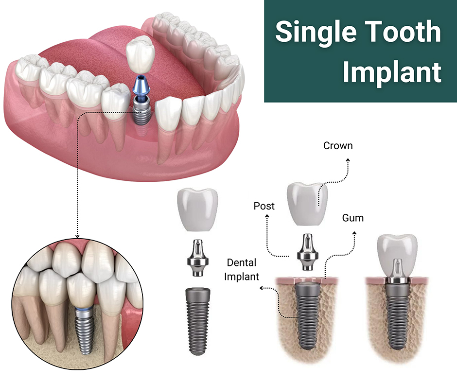 Cấy ghép Implant
